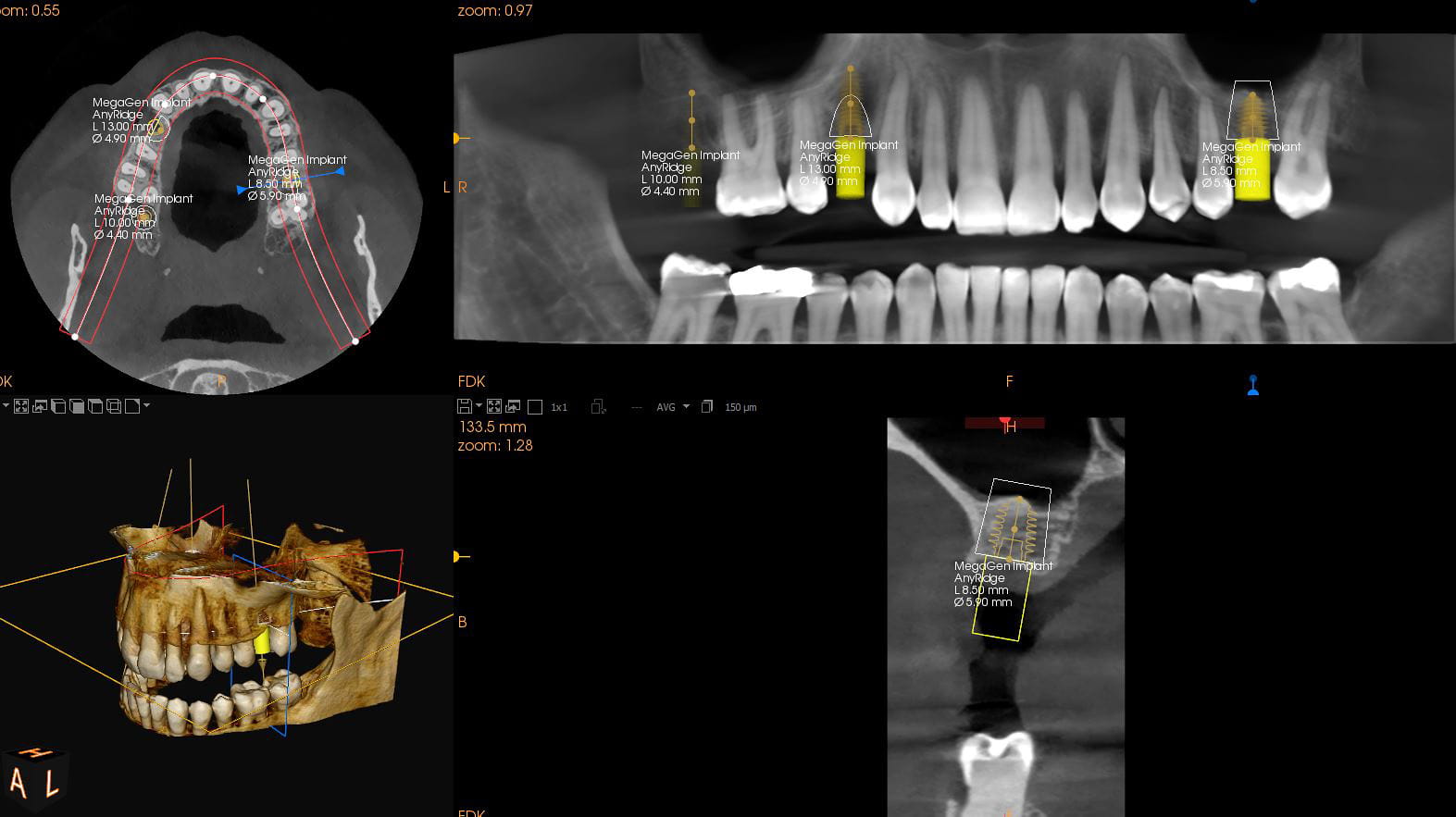 CBCT-optagelse delt via DenTec filetransfer